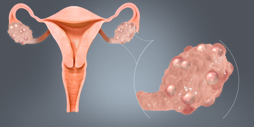 Polycystic_Ovaries